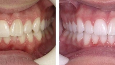 Class I with Class III tendency - Crowding (SureSmile Aligners)