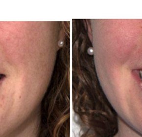 Class I – Crowding, Shallow Overbite (SureSmile Aligners)