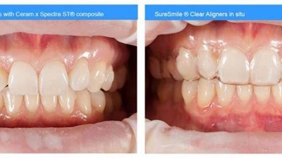 Bonded attachments with Ceram.x Spectra ST universal composite restorative for SureSmile Clear Aligners