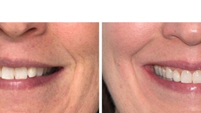 Mild Class II – Narrow Arches (SureSmile Aligners)