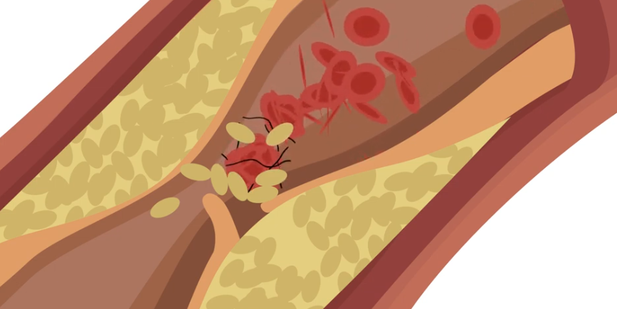 Diagram showing a blocked artery causing a heart attack.